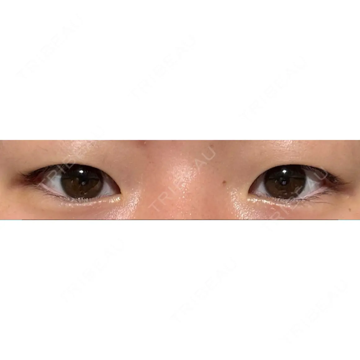 二重埋没 / 目頭切開 / 上まぶたの脂肪取り LUHO（ルホ）美容外科 AFTER