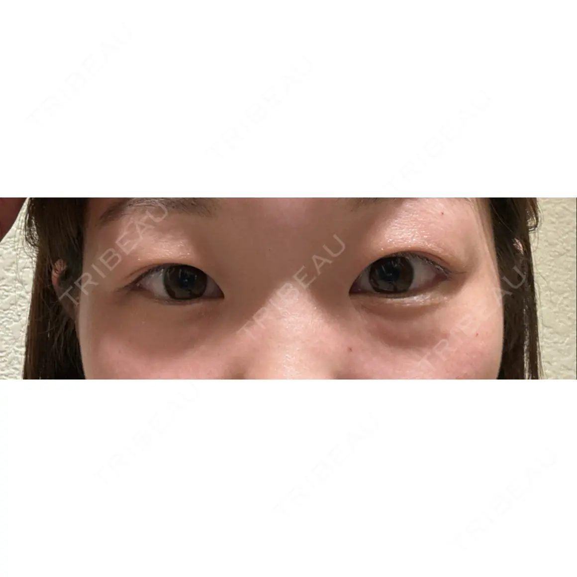 二重埋没 / クマ治療 / 上まぶたの脂肪取り 9BeautyClinic AFTER