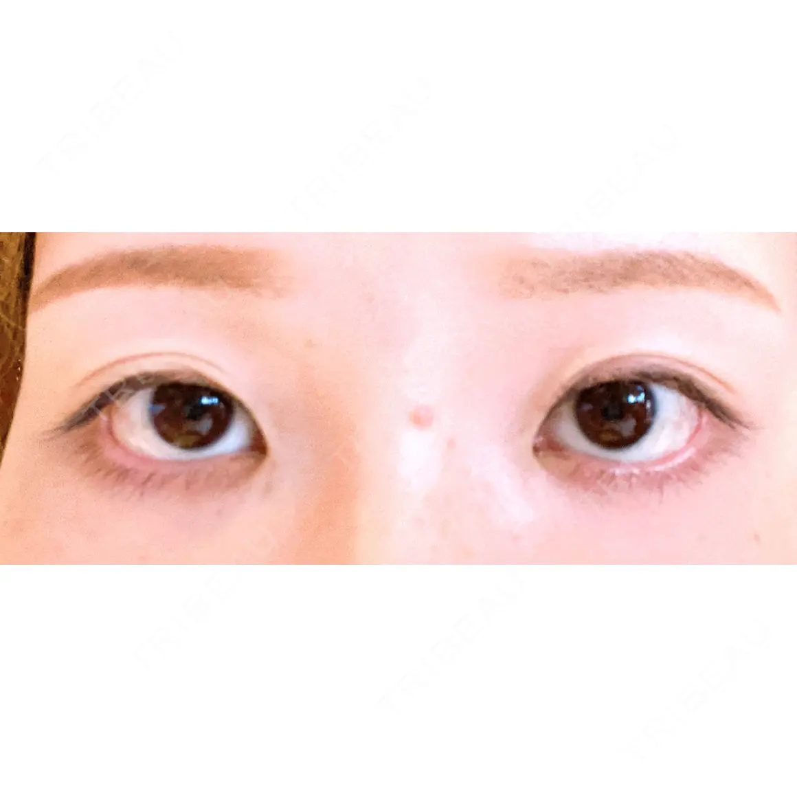 二重埋没 / 目頭切開 yuzawa clinic AFTER