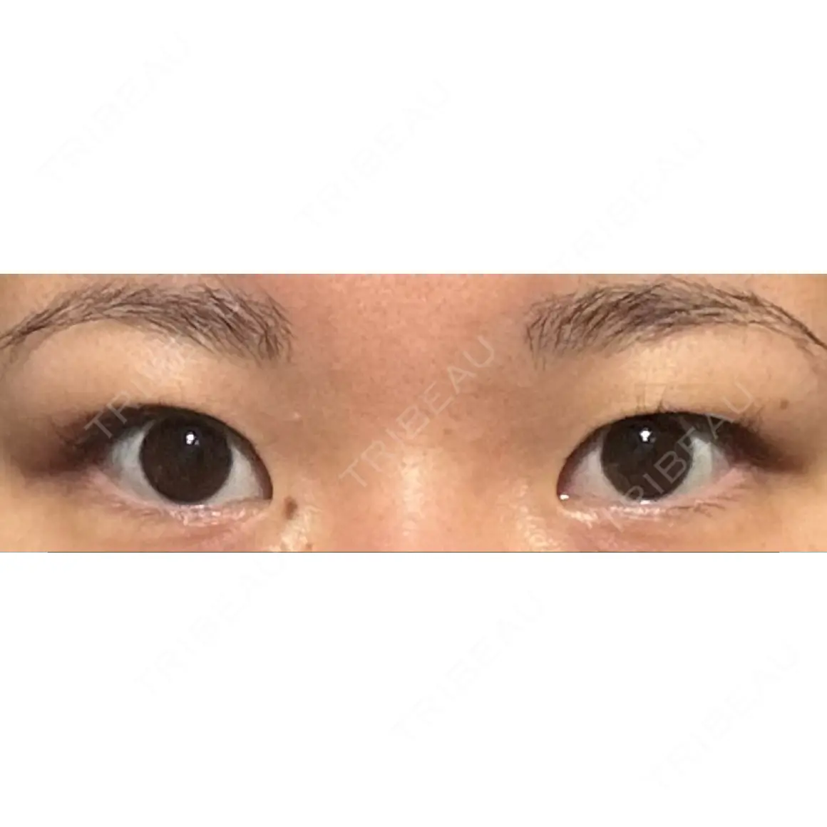 二重埋没 / 上まぶたの脂肪取り 9BeautyClinic AFTER