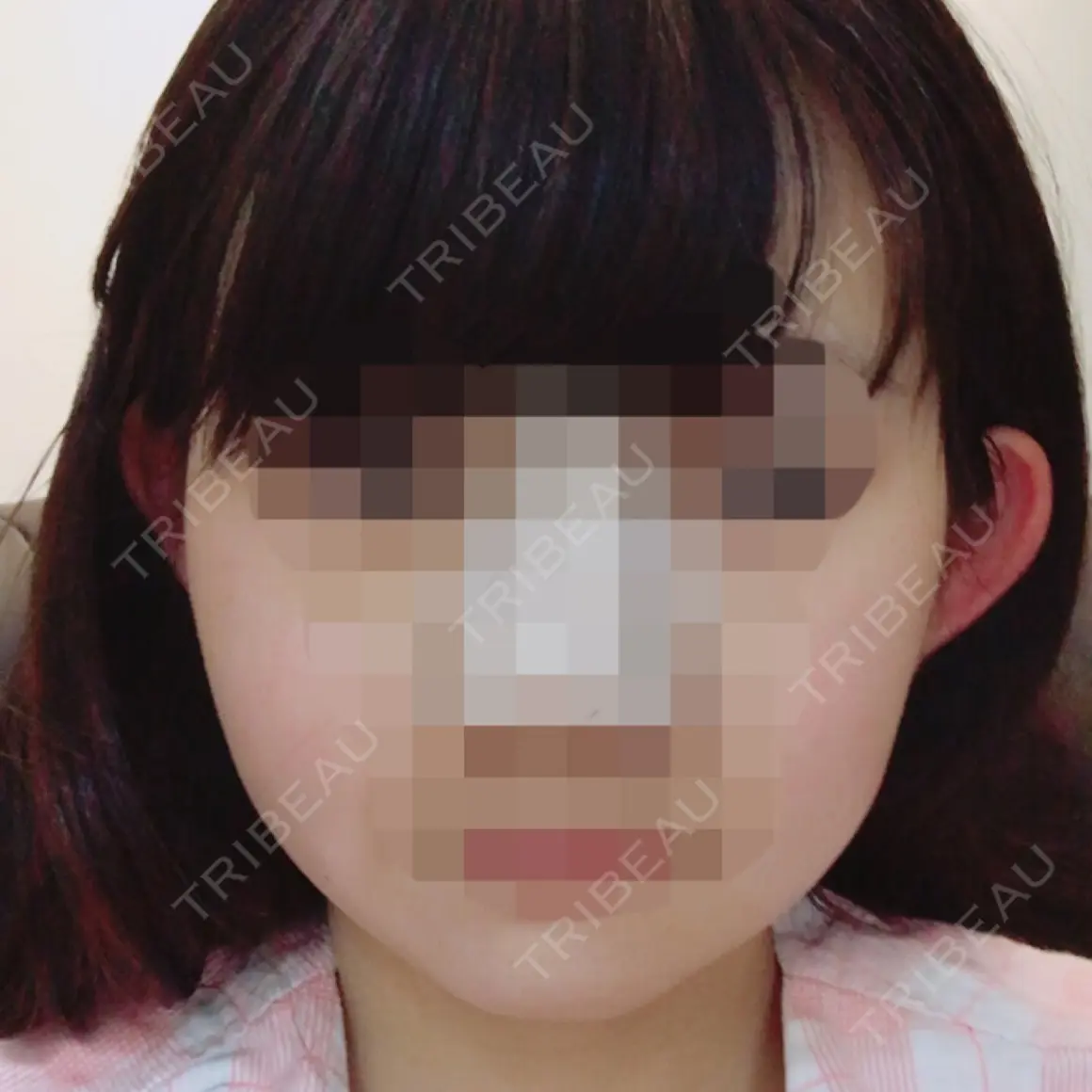 バッカルファット除去 / 脂肪吸引（顔） / ヒアルロン酸注入（あご） / ボトックス（エラ・小顔） / ヒアルロン酸溶解 エートップ美容整形外科 AFTER