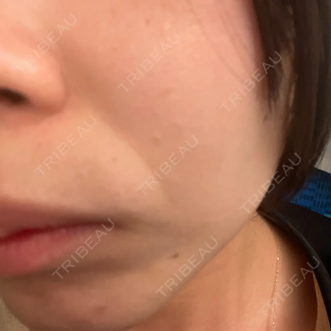 医療脱毛（全身） 新宿美容外科クリニック 新宿院 AFTER