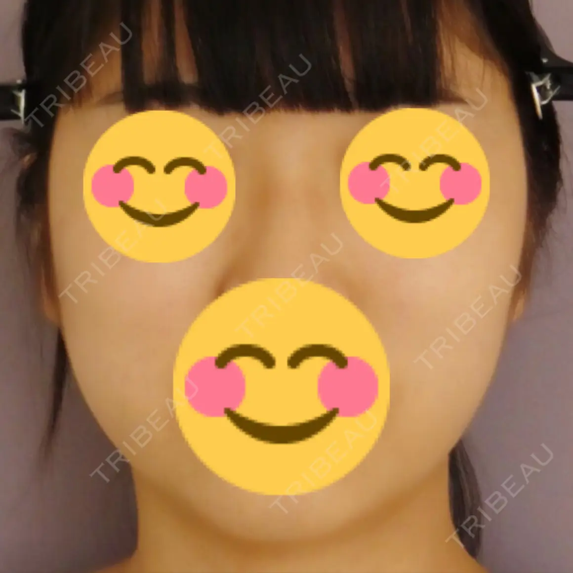 バッカルファット除去 / 脂肪吸引（顔） / ボトックス（エラ・小顔） 藤・ナチュレ美容クリニック 恵比寿院 AFTER