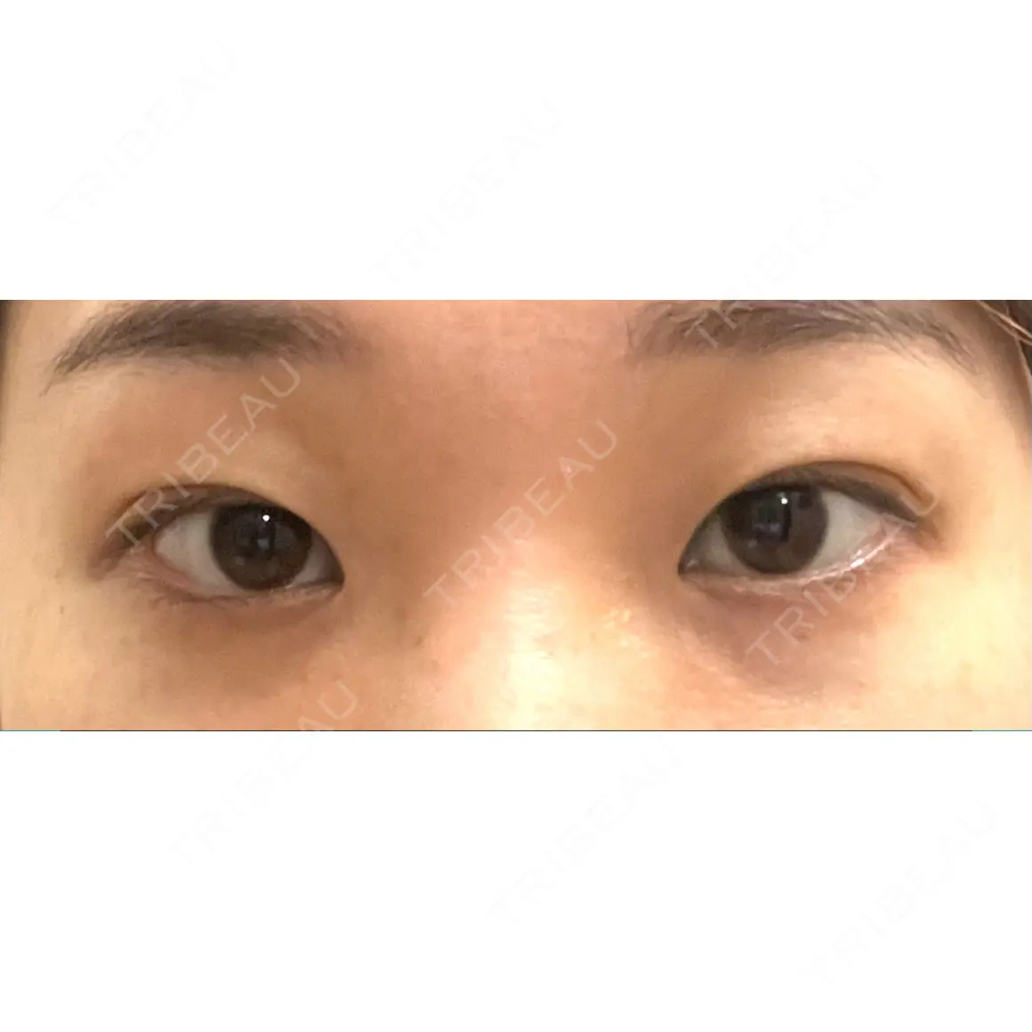目頭切開 / 目尻切開 / タレ目形成・グラマラスライン（切開） / 自然癒着法 プロミス整形外科 AFTER