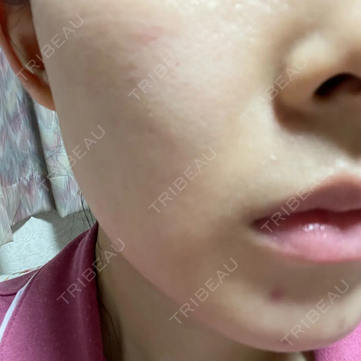 エレクトロポレーション Kinshicho Beauty Clinic （錦糸町ビューティークリニック） AFTER