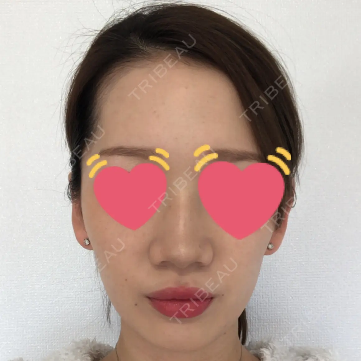 小鼻縮小（切開） / 糸リフト / 鼻尖縮小 / ヒアルロン酸注入（鼻） / ハイフ（顔） ヴェリテクリニック 大阪院 AFTER