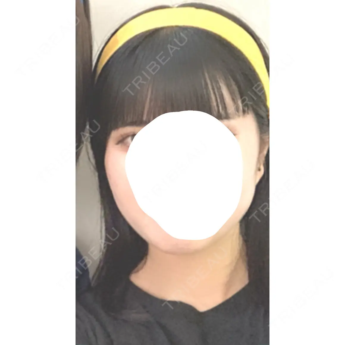 ボトックス（エラ・小顔） さっぽろ美容クリニック AFTER