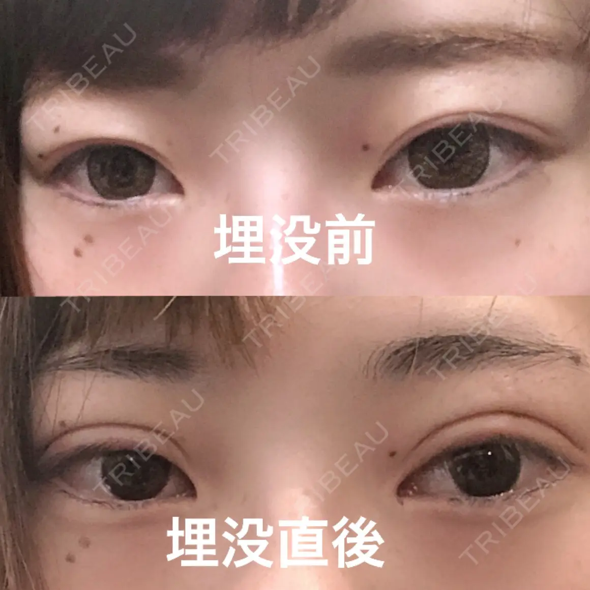 二重埋没 / 上まぶたの脂肪取り 湘南美容クリニック 柏院 AFTER