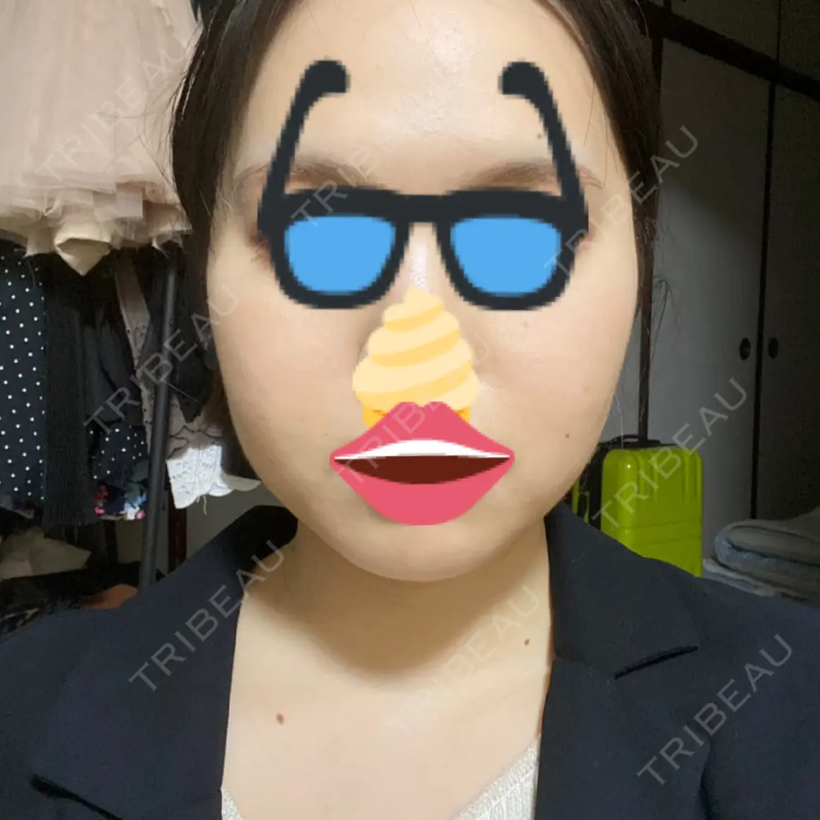 ボトックス（エラ・小顔） 共立美容外科 新宿本院 AFTER