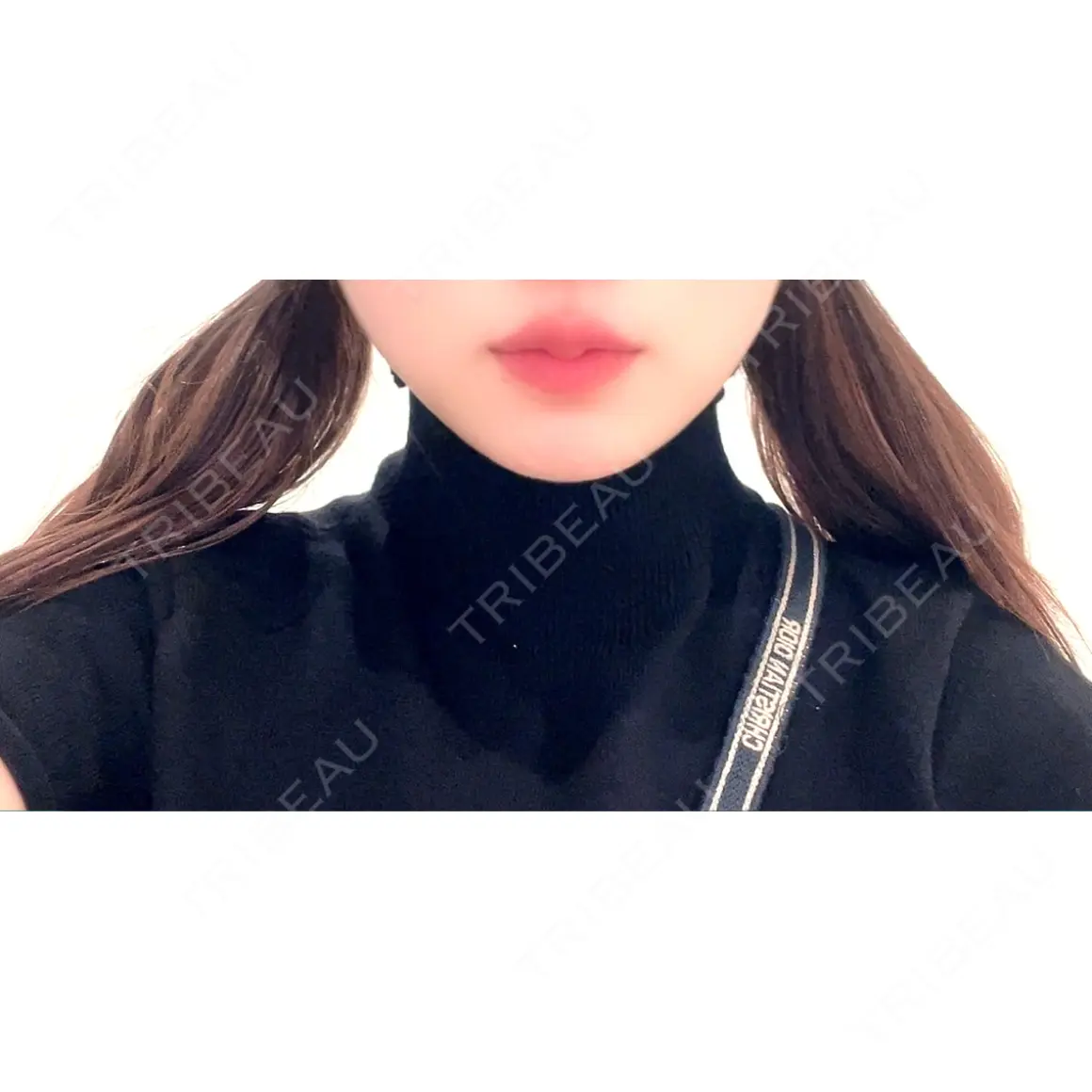 ヒアルロン酸注入（唇） / ボトックス（口角） フィラークリニック 新宿院 AFTER
