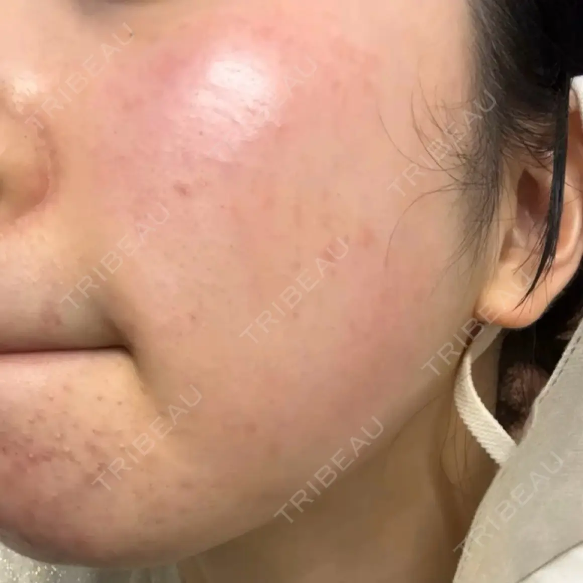 エレクトロポレーション Kinshicho Beauty Clinic （錦糸町ビューティークリニック） AFTER