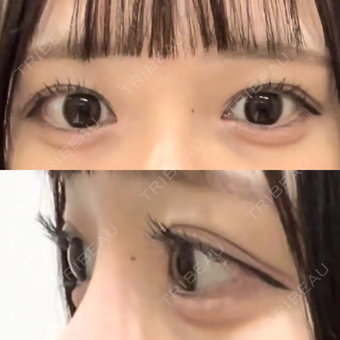 眉下切開 / ボトックス（額） Otus Clinic 【オータスクリニック】 AFTER