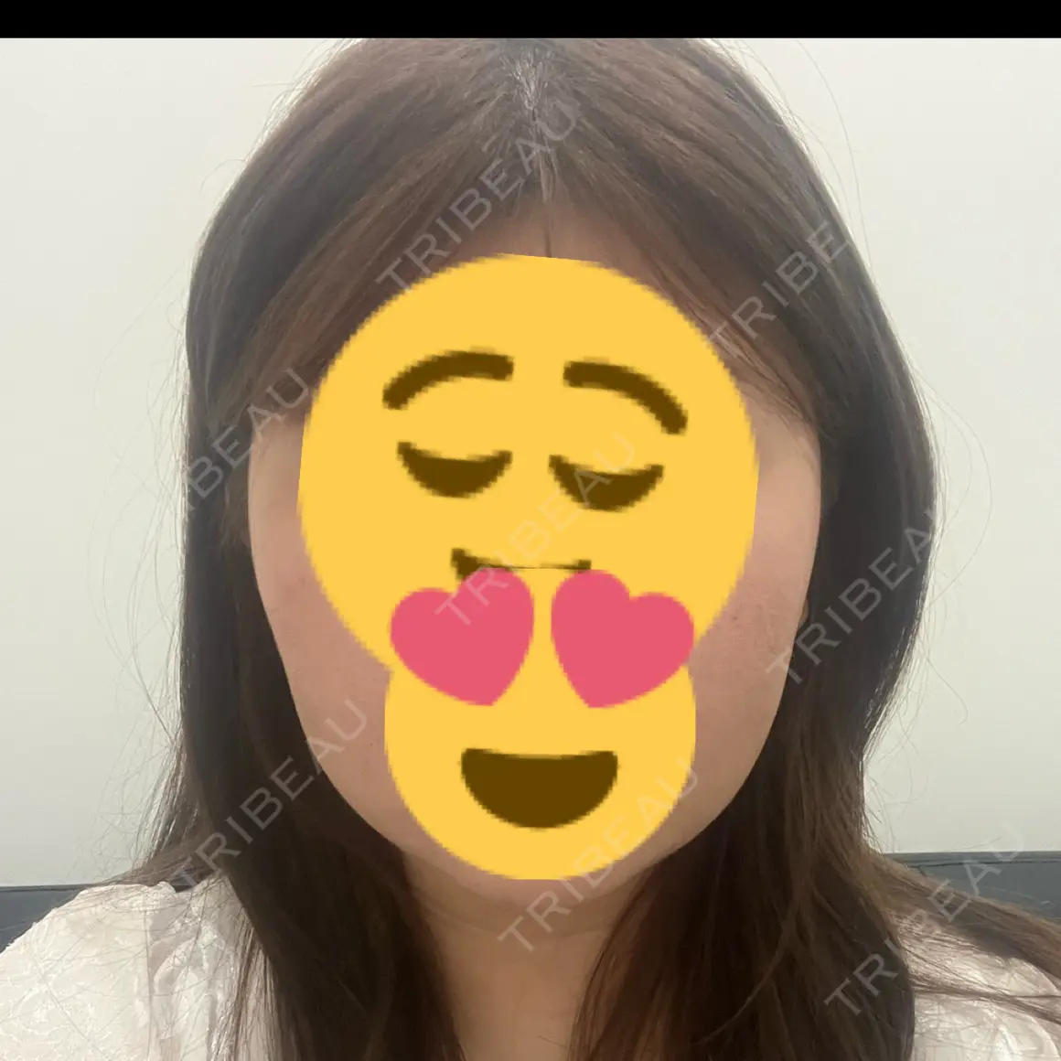 バッカルファット除去 MIL CLINIC OSAKA AFTER