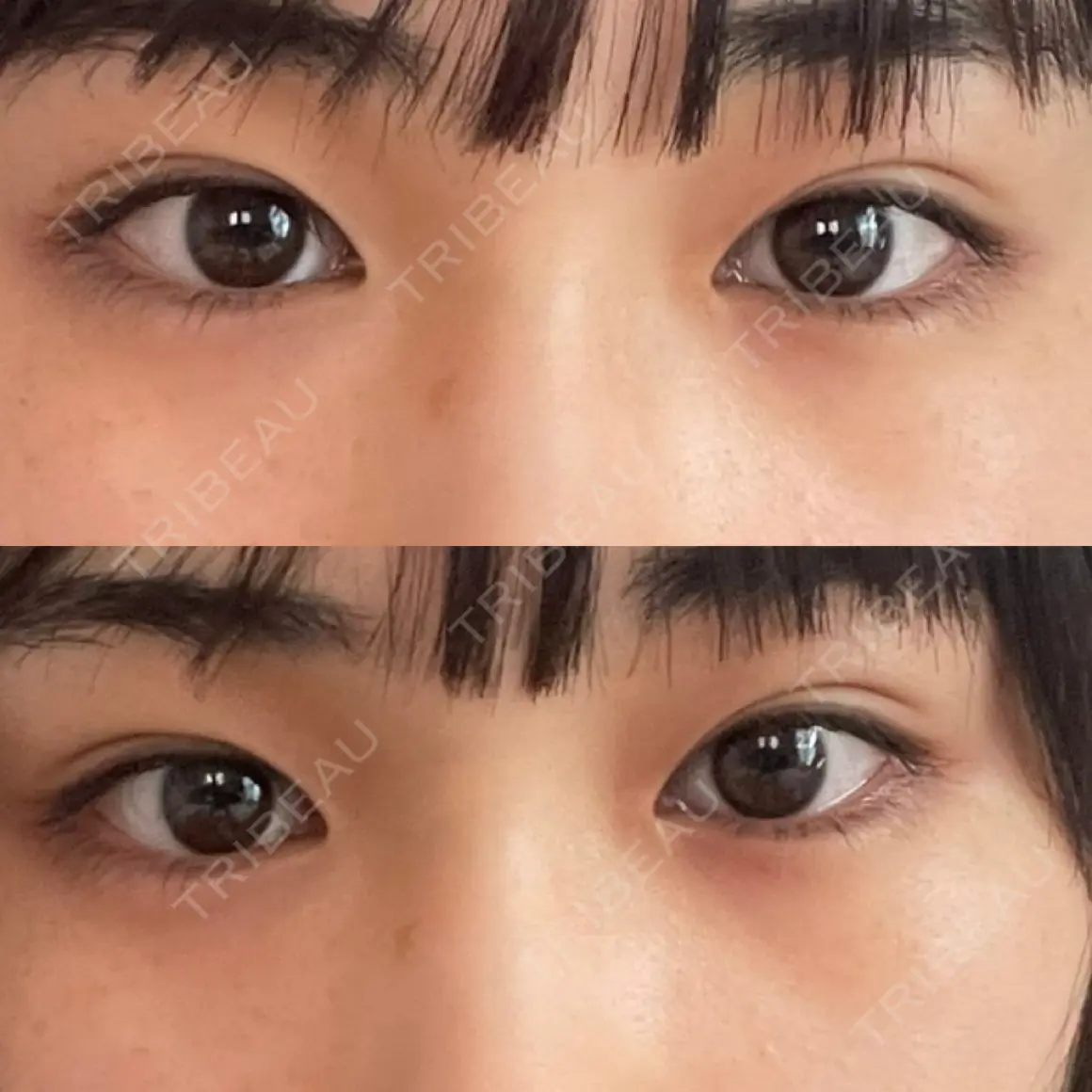 二重埋没 Brandnew Beauty Clinic AFTER