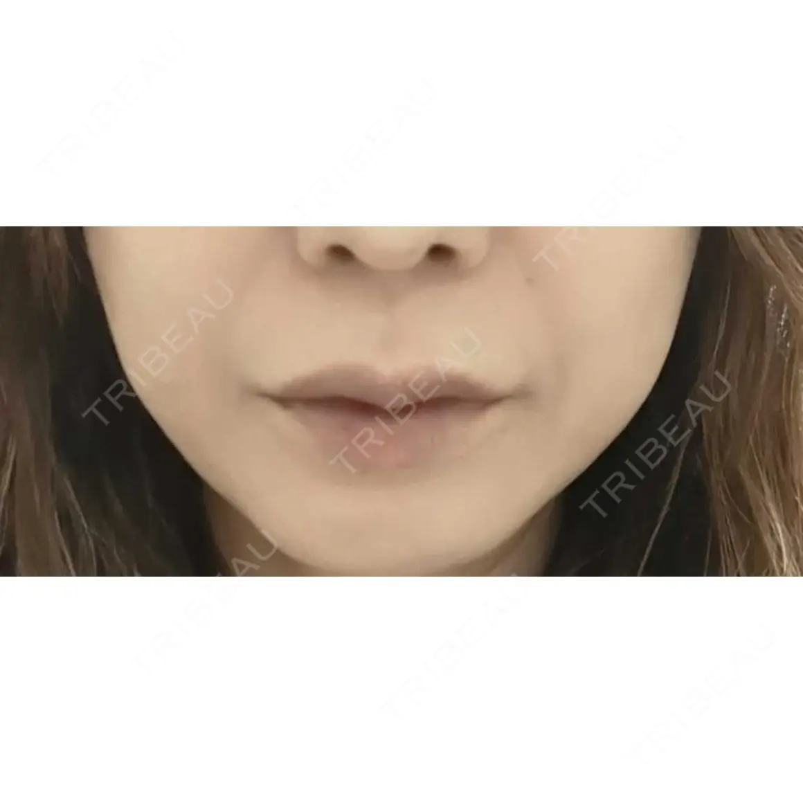 ヒアルロン酸注入（唇） / ボトックス（口角） / ボトックス（人中） Otus Clinic 【オータスクリニック】 AFTER
