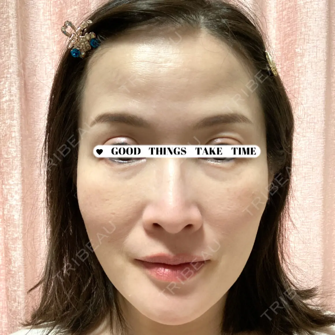 脂肪吸引（脚） / 脂肪吸引（お尻） / 脂肪注入（輪郭） Mods Clinic（モッズクリニック） 名古屋院 AFTER