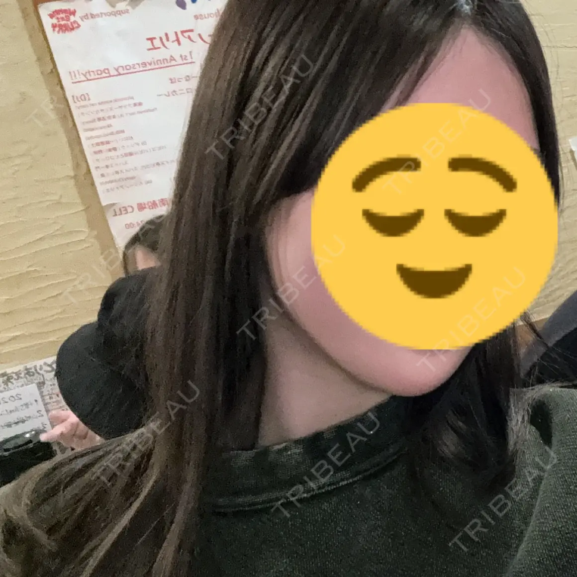 ボトックス（エラ・小顔） AYANAフィラーズクリニック 渋谷院 AFTER