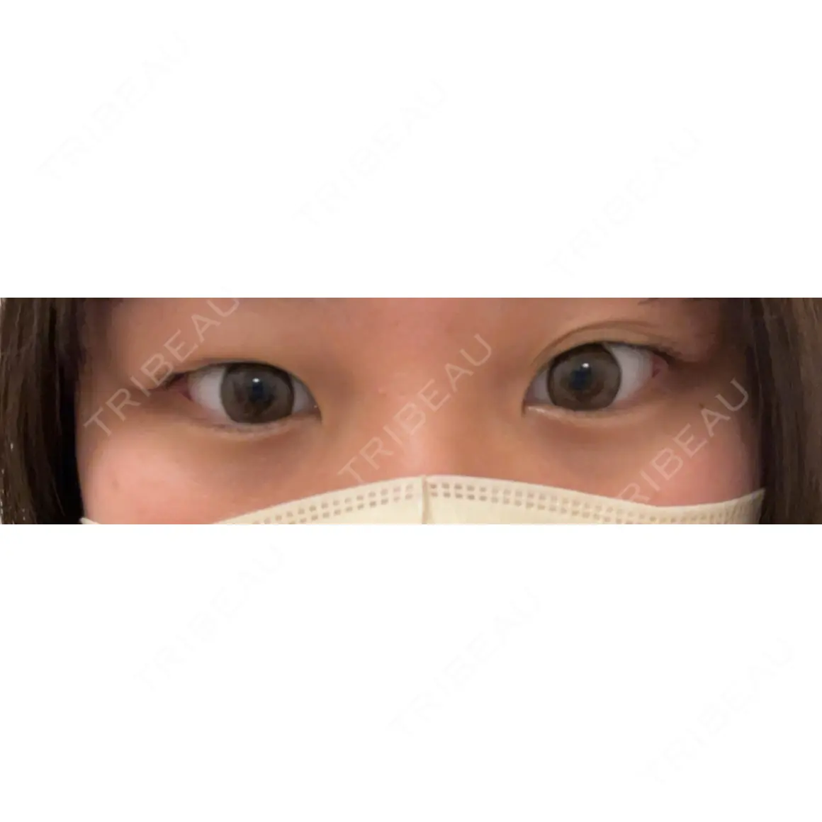 二重埋没 THE FIRST CLINIC 多摩センター院 AFTER