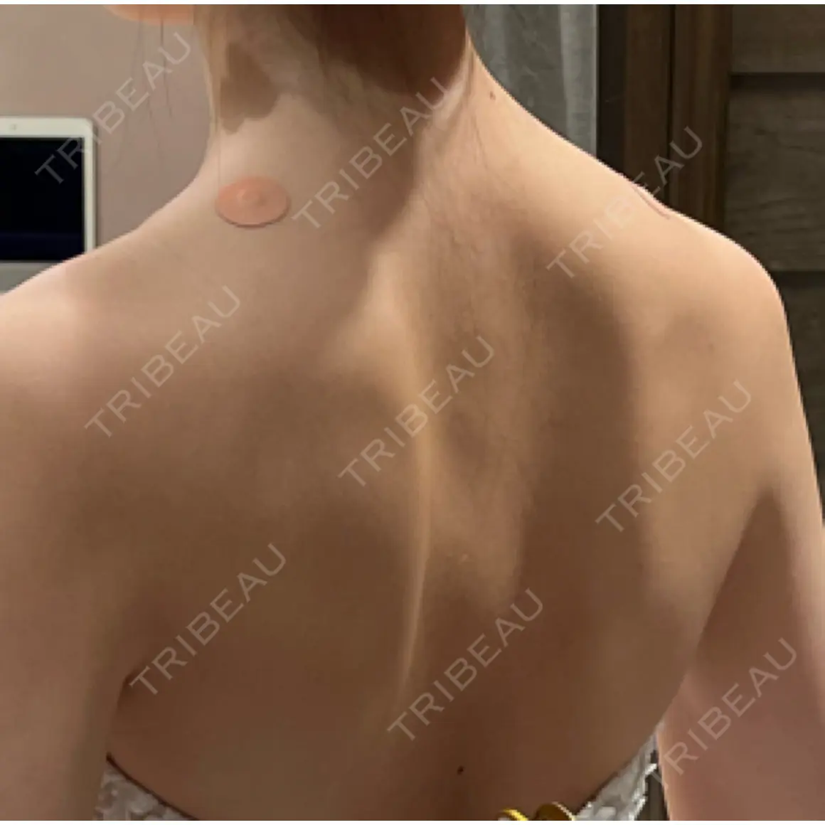 ボトックス（肩） 共立美容外科 浜松院 AFTER