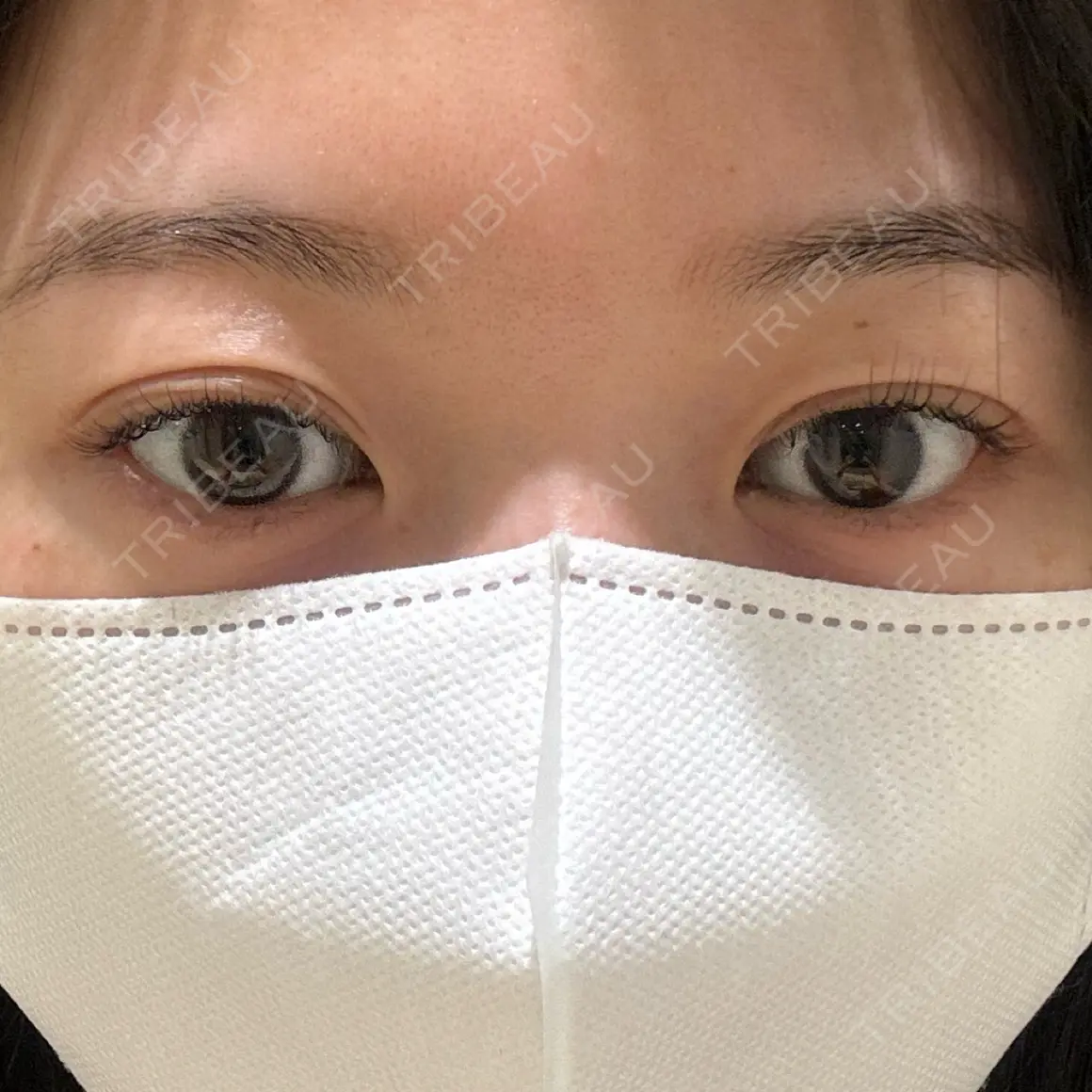 二重埋没 THE FIRST CLINIC 多摩センター院 AFTER