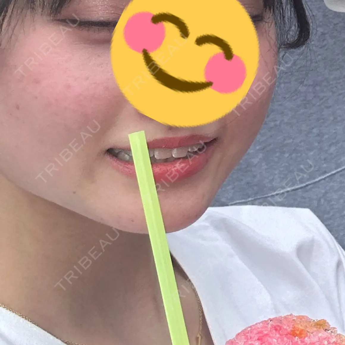 ボトックス（エラ・小顔） 共立美容外科 新宿本院 AFTER