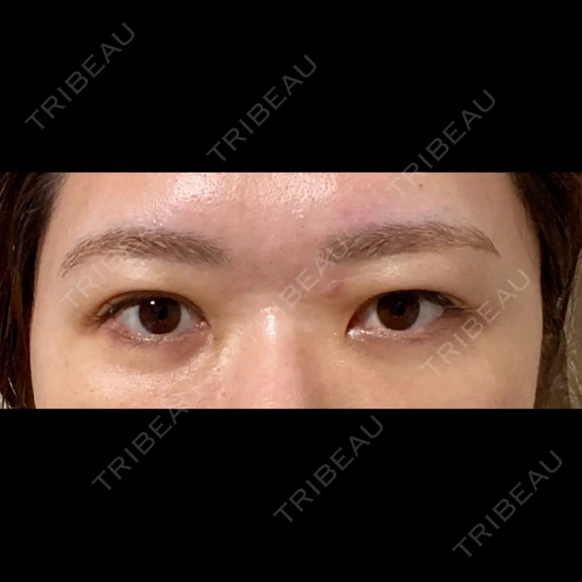 二重埋没 / 上まぶたの脂肪取り THE FIRST CLINIC 多摩センター院 AFTER