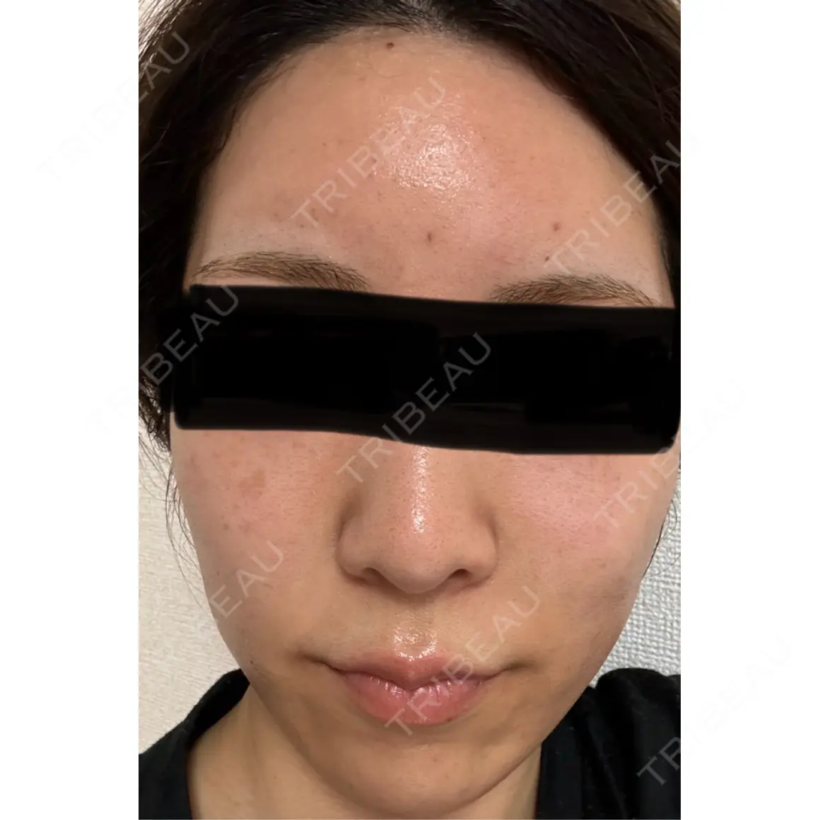 ヒアルロン酸注入（あご） / ヒアルロン酸注入（額） MIO CLINIC 梅田院 AFTER