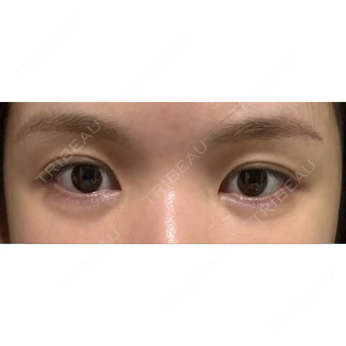 目頭切開 / タレ目形成・グラマラスライン（切開） HAAB×DREAM BEAUTY CLINIC 東京本院 AFTER