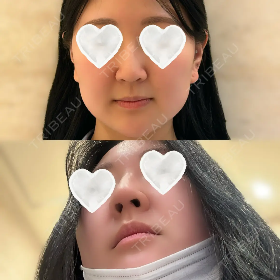 鼻中隔延長（切開） / 軟骨移植 / 骨切幅寄せ / ワシ鼻修正・ハンプ切除 / 鼻尖縮小 LUHO（ルホ）美容外科 AFTER