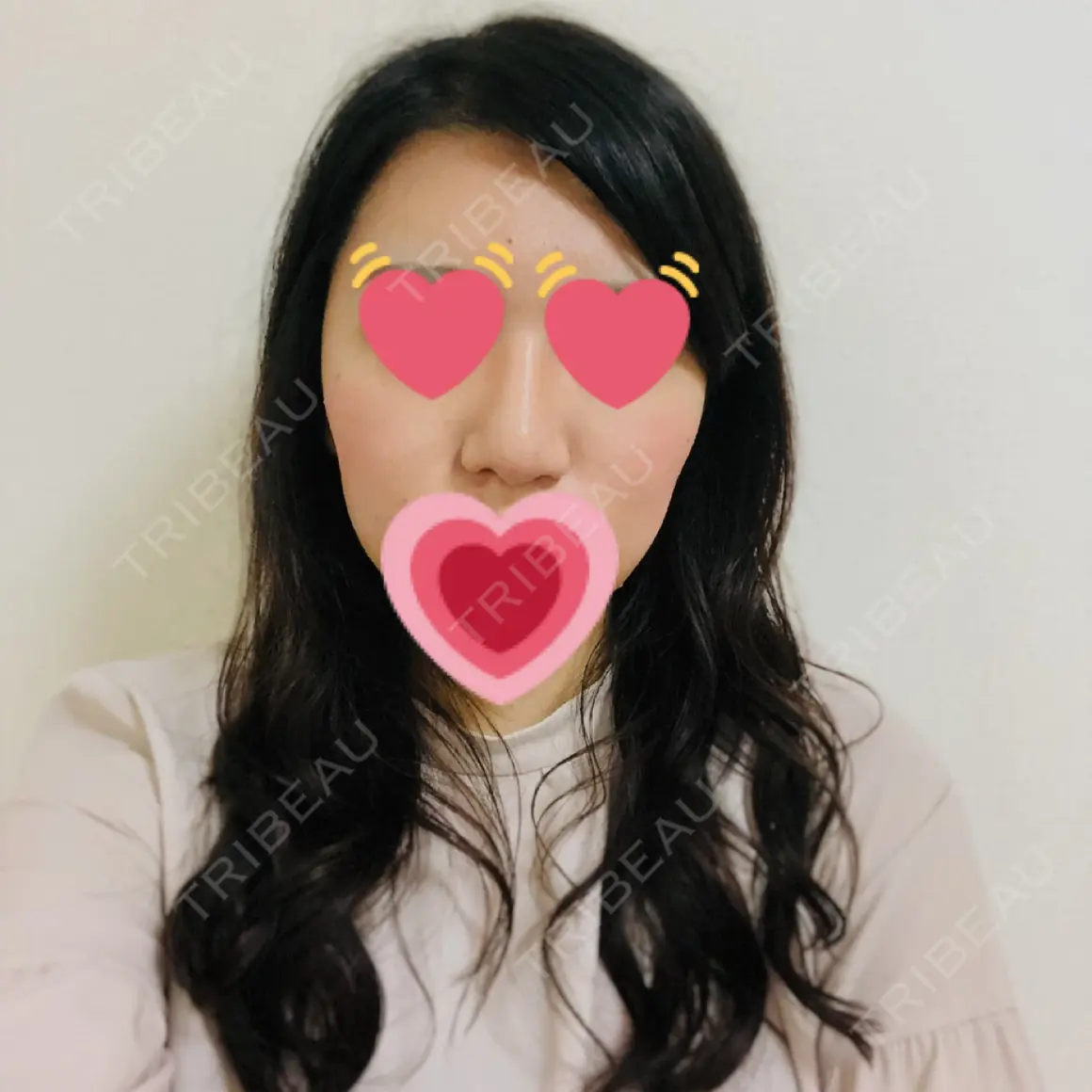 隆鼻術 / 鼻尖形成（切開） / 鼻中隔延長（切開） / 骨切幅寄せ / 眉間プロテーゼ / プロテーゼ除去 / 鼻尖縮小 FROM B整形外科 (旧バウム整形外科) AFTER