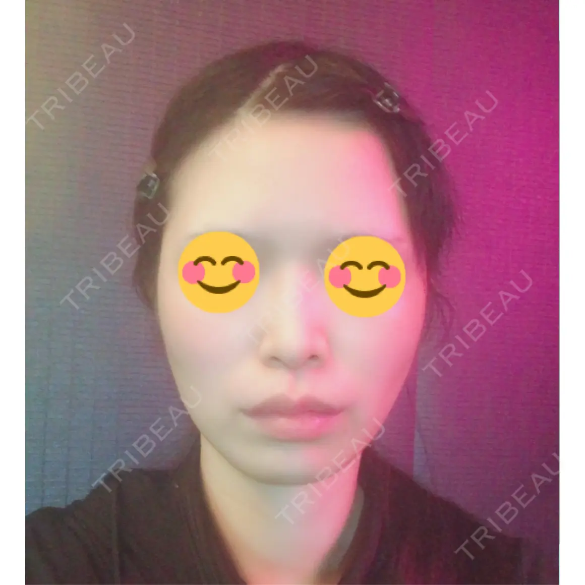 脂肪注入（肌） EMMO FACE CLINIC 大宮院 AFTER
