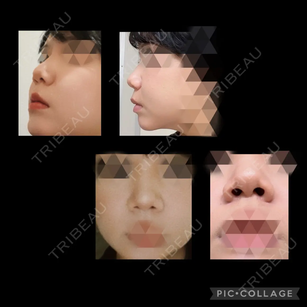隆鼻術 / 鼻尖形成（切開） / 鼻中隔延長（切開） / 骨切幅寄せ / ワシ鼻修正・ハンプ切除 LUHO（ルホ）美容外科 AFTER