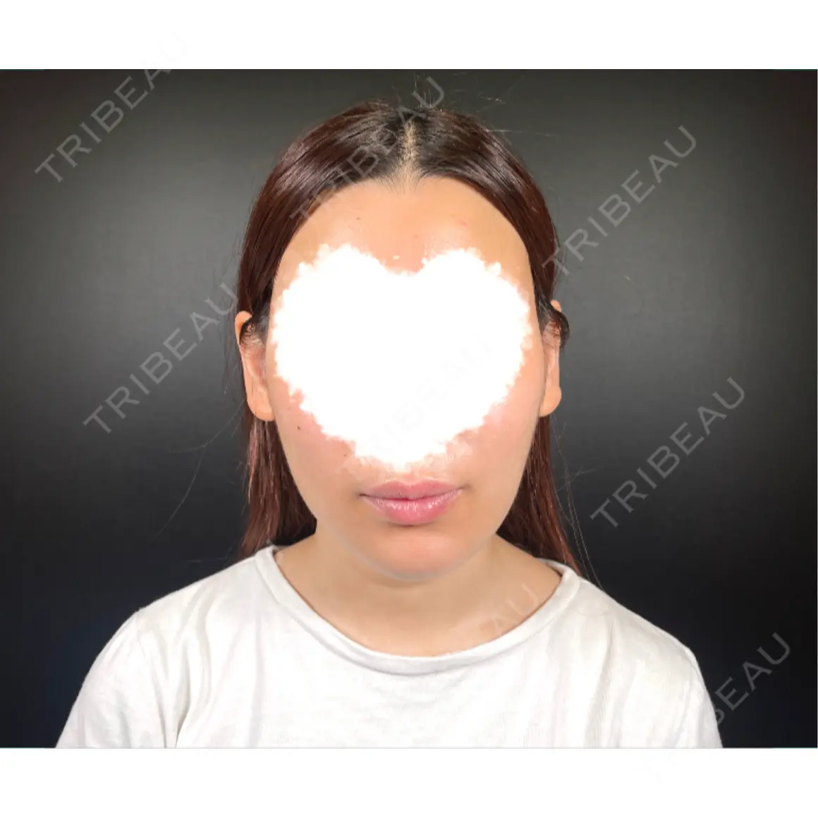 二重切開 / 糸リフト / 脂肪吸引（顔） R Beauty CLINIC 銀座院 AFTER