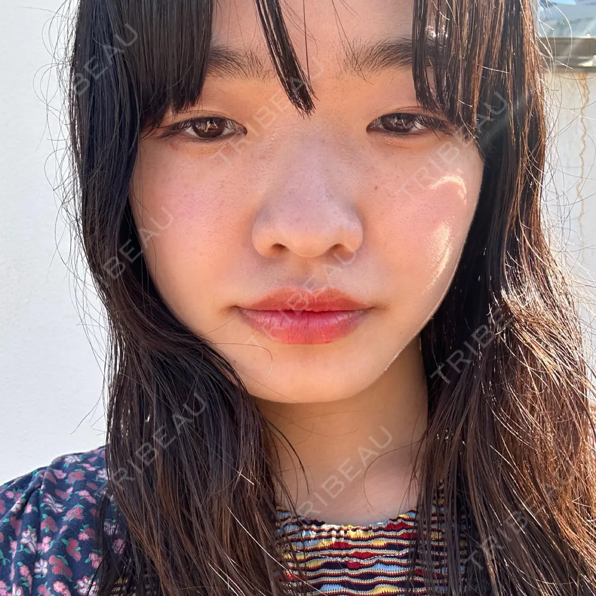 二重埋没 湘南美容クリニック 西葛西院 AFTER