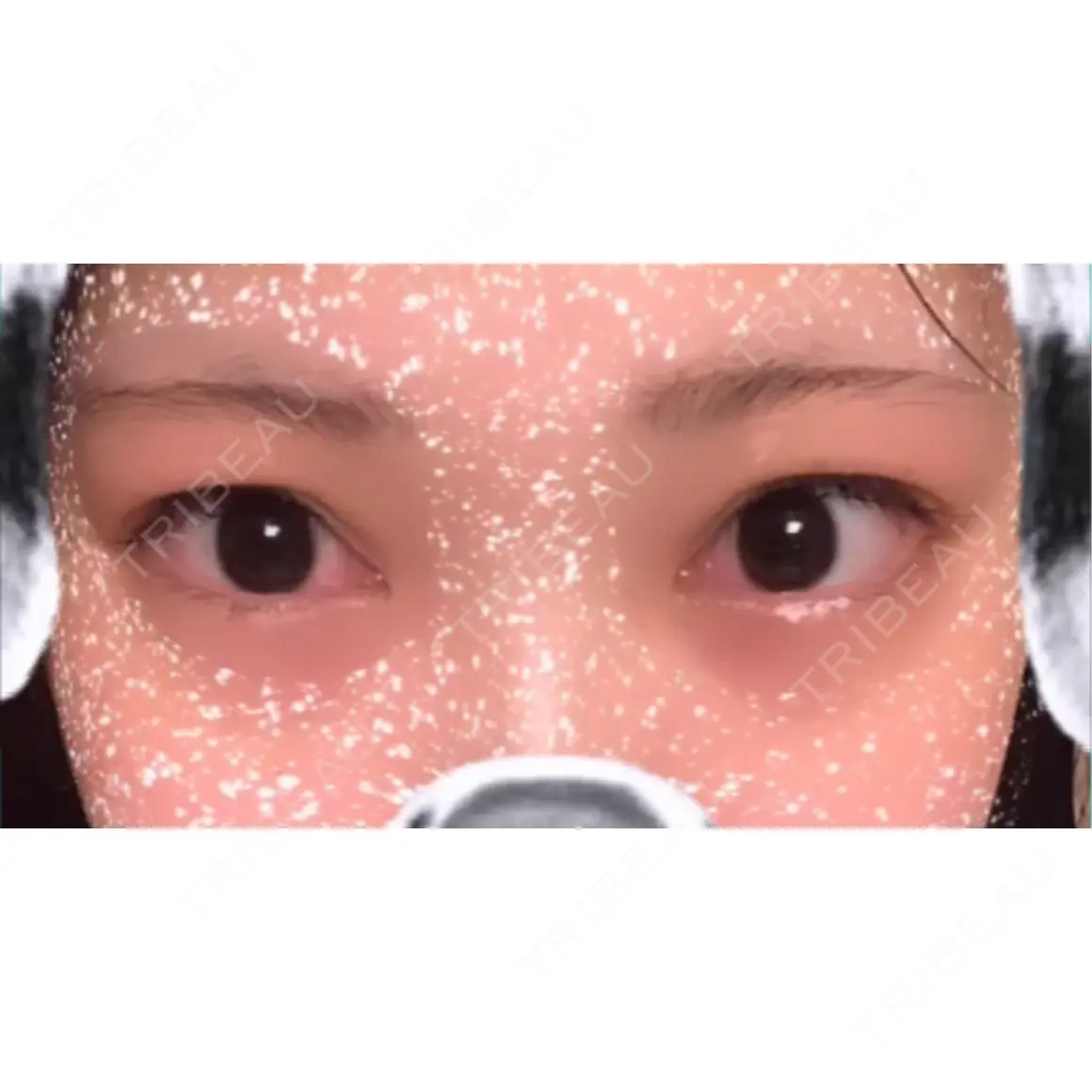 二重埋没 / 上まぶたの脂肪取り HAAB×DREAM BEAUTY CLINIC 東京本院 AFTER