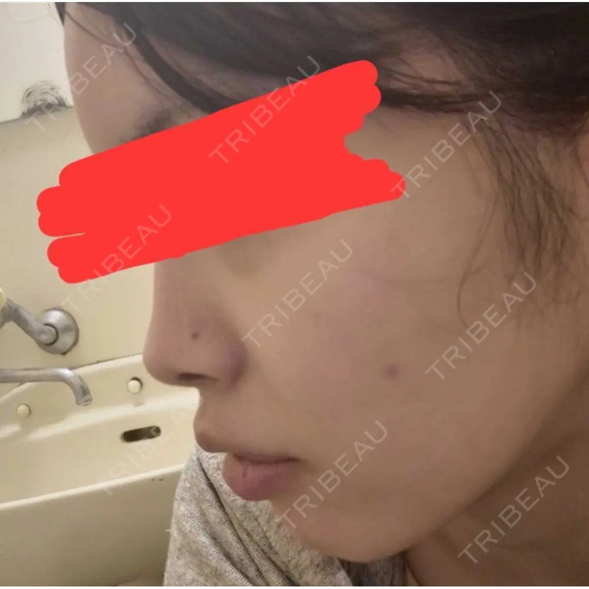 ボトックス（首） / ヒアルロン酸注入（鼻翼基部） KAGA CLINIC AFTER