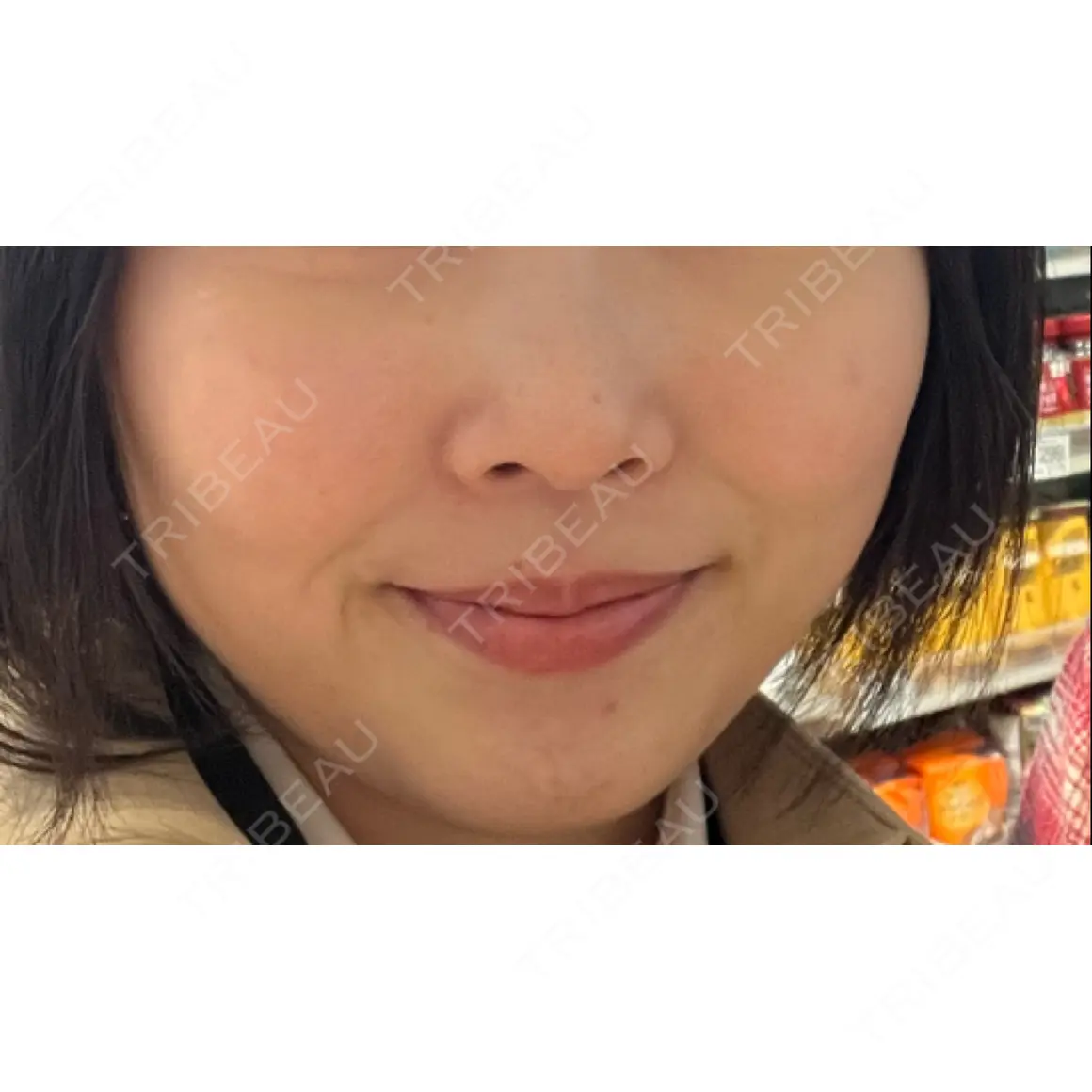 ほくろ・いぼ除去レーザー（肌） 西新宿杉江中央クリニック AFTER