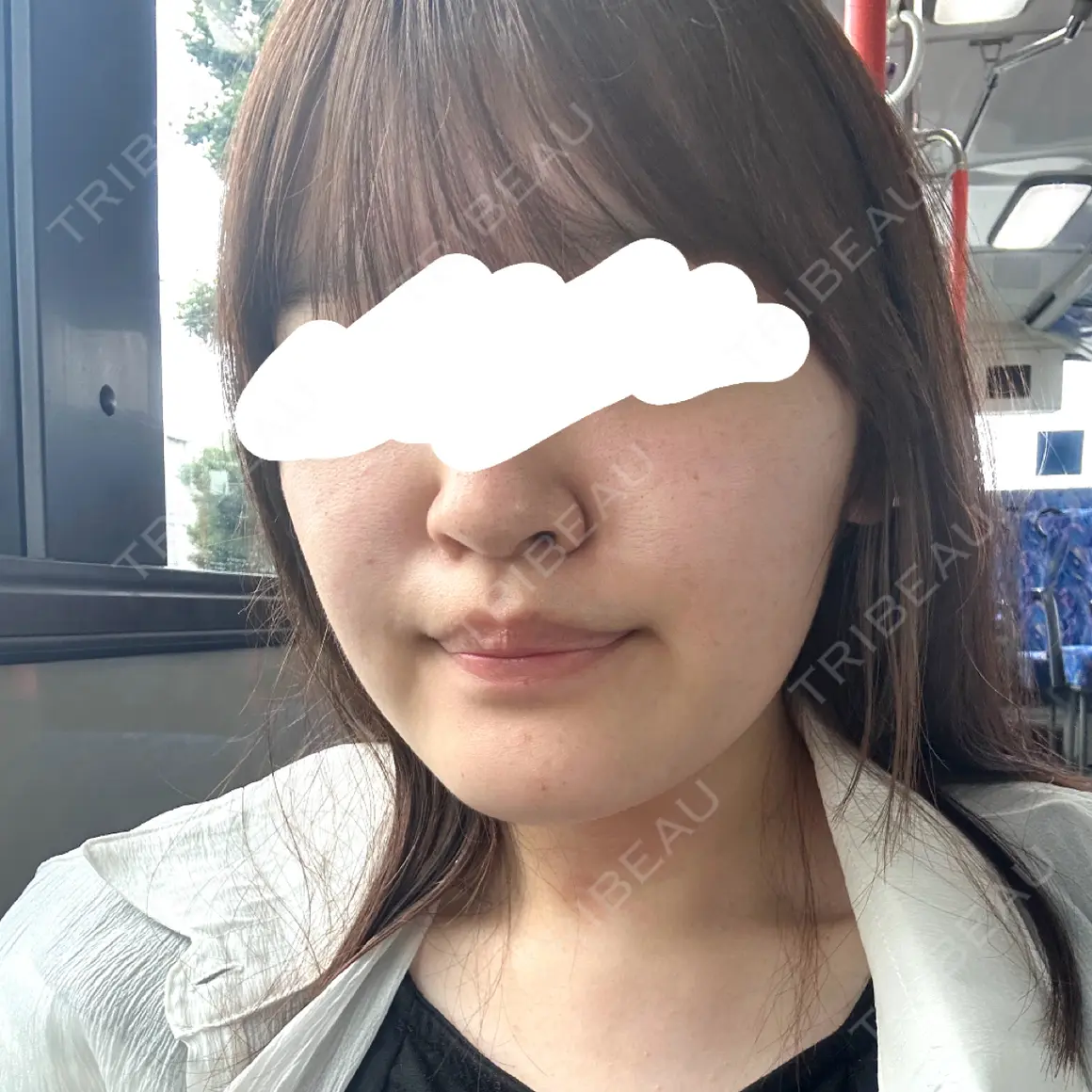 骨切り（あご） 銀座マイアミ美容外科 AFTER