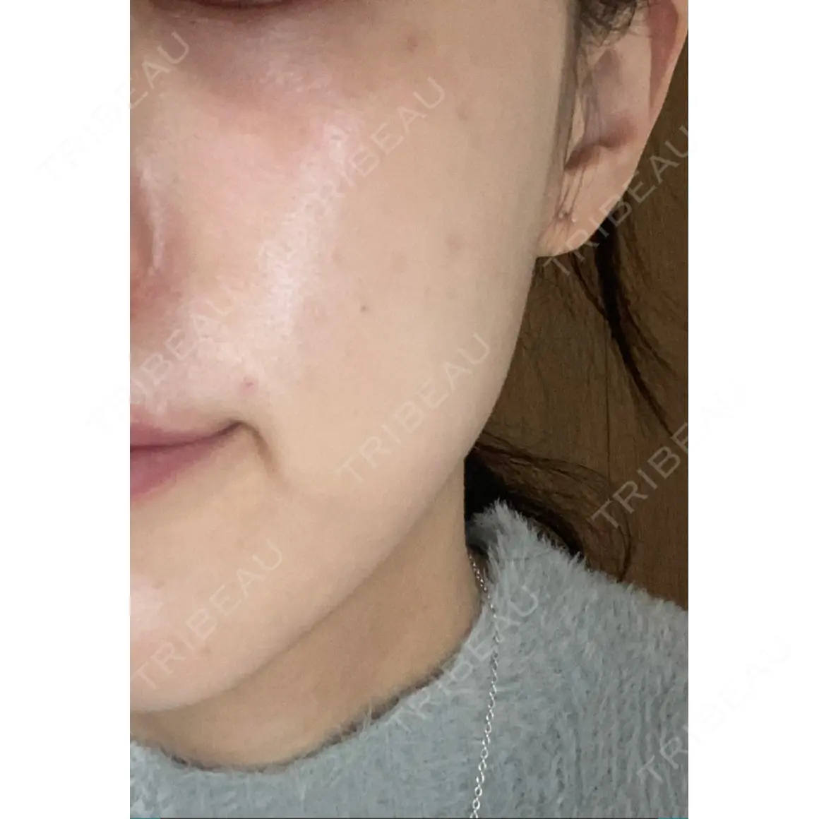 その他（肌） 美容皮膚科 デュークリニック AFTER