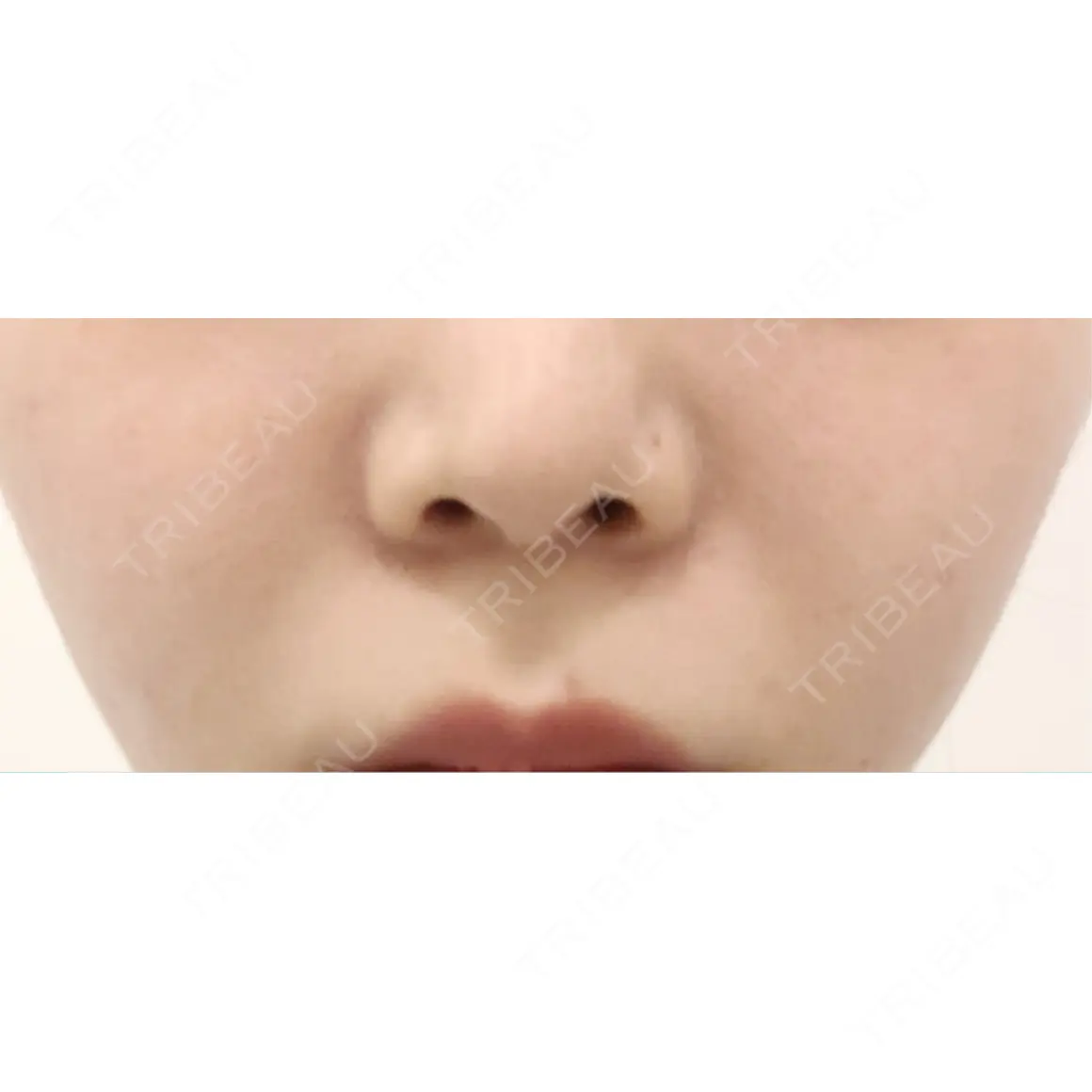 小鼻縮小（非切開） ASTRA BEAUTY CLINIC AFTER