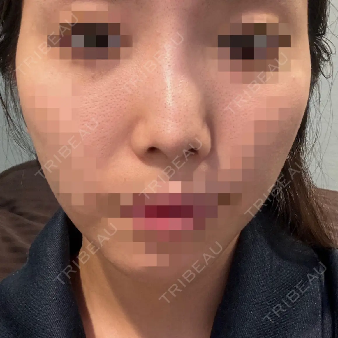隆鼻術 / 鼻尖形成（切開） / 鼻中隔延長（切開） / 軟骨移植 / 骨切幅寄せ / 鼻修正 / 鼻尖縮小 銀座マイアミ美容外科 AFTER