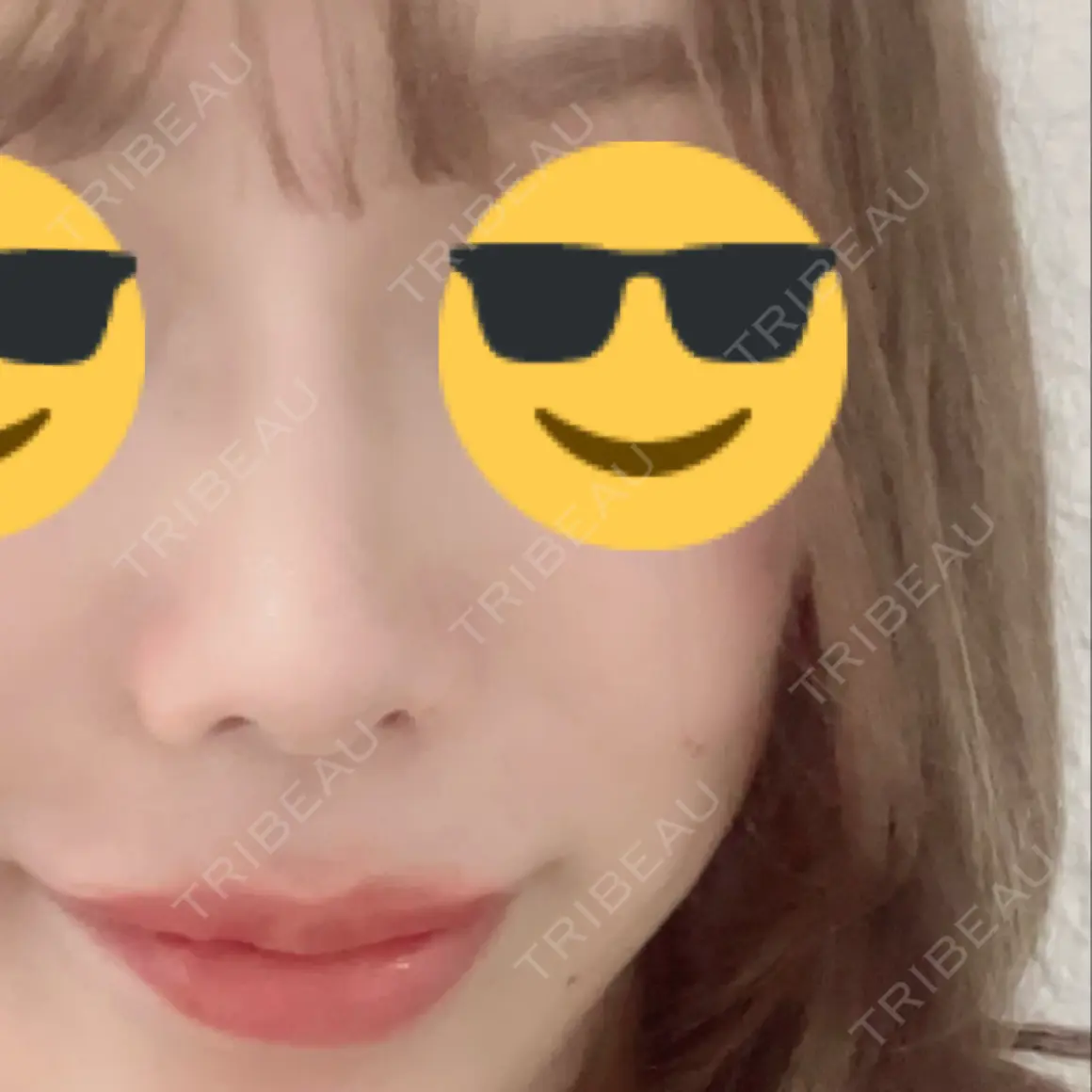 スレッドノーズ / 鼻中隔延長（非切開） ASTRA BEAUTY CLINIC AFTER