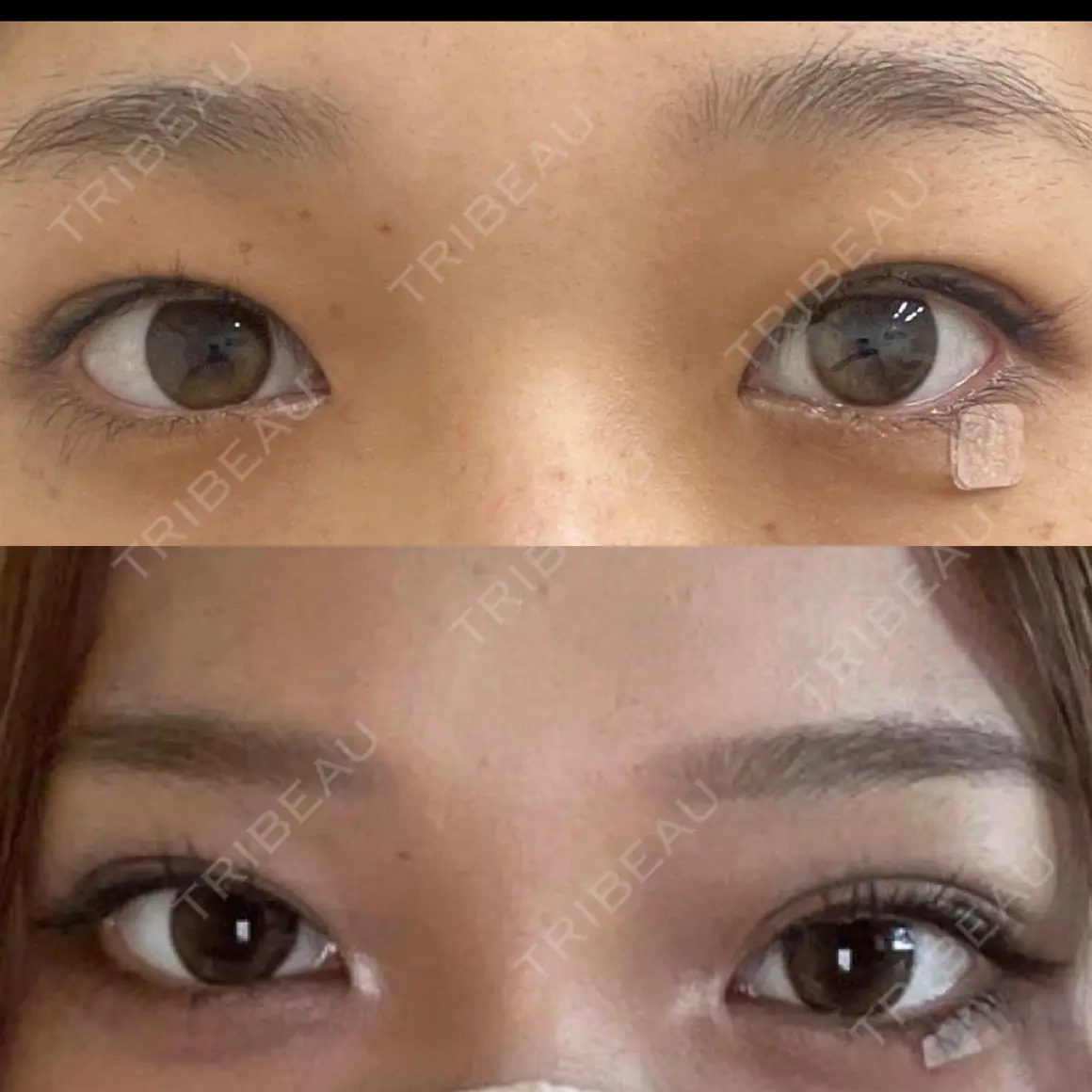 二重埋没 湘南美容クリニック 西葛西院 AFTER