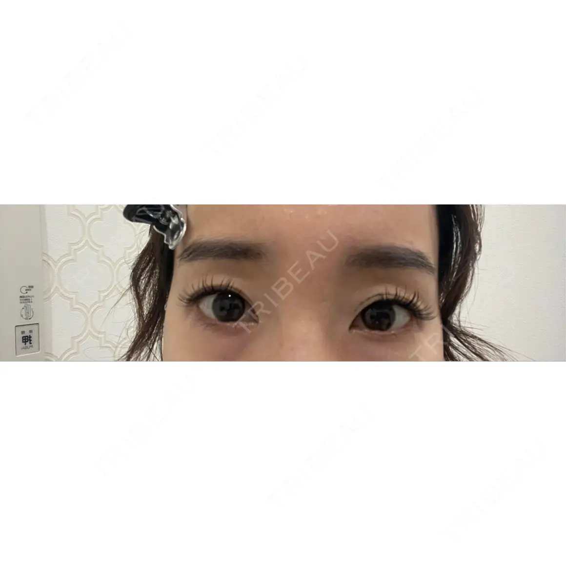 二重埋没 / ヒアルロン酸注入（目の下） BELINDA CLINIC（ベリンダクリニック）岡山院 AFTER