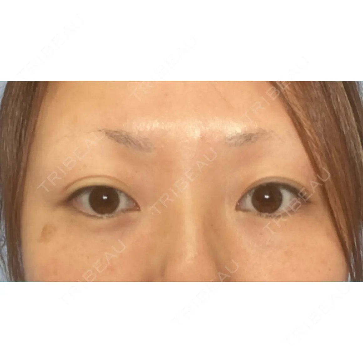 二重埋没 湘南美容クリニック 西葛西院 AFTER