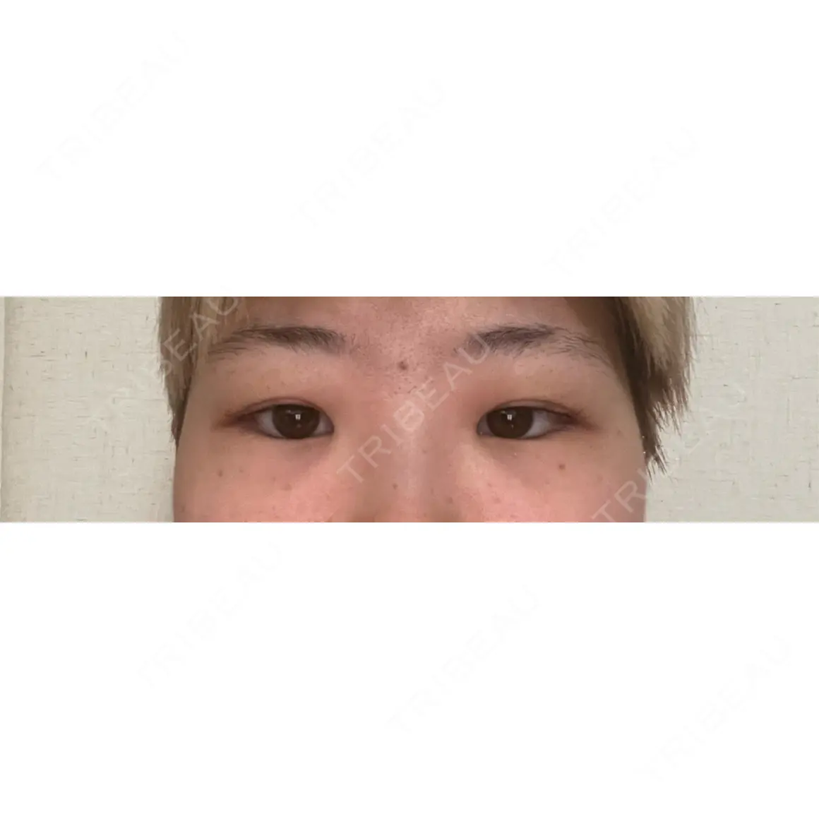 目頭切開 高須クリニック 名古屋院 AFTER