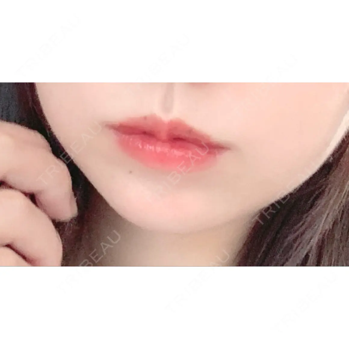 ほくろ・いぼ除去レーザー（肌） 川崎中央クリニック AFTER