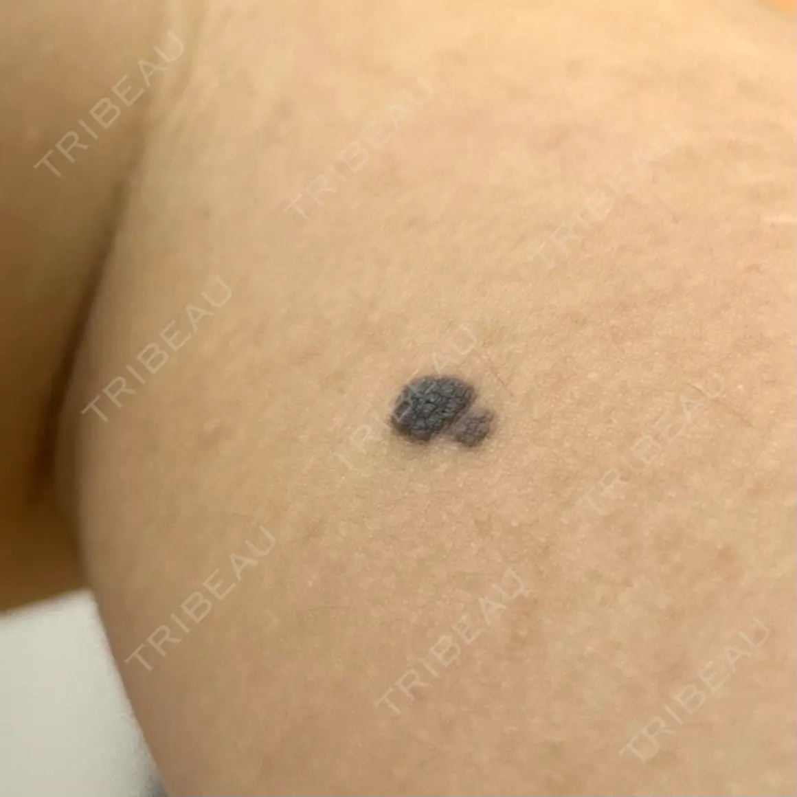 ほくろ・いぼ切除（肌） KARIS beauty clinic AFTER