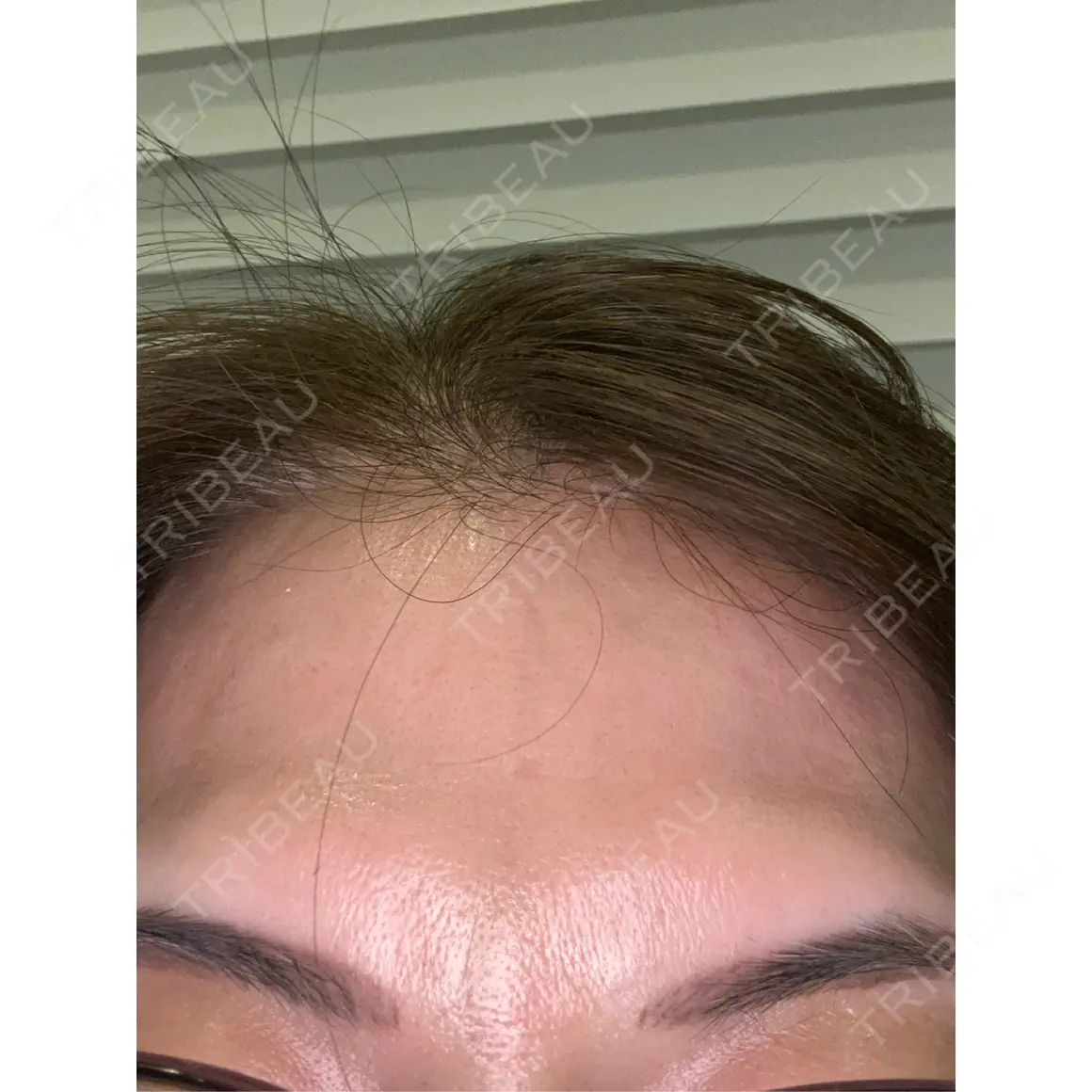 ボトックス（眉間） / ボトックス（額） WellnessPlus Clinic 【ウェルネスプラスクリニック】 AFTER
