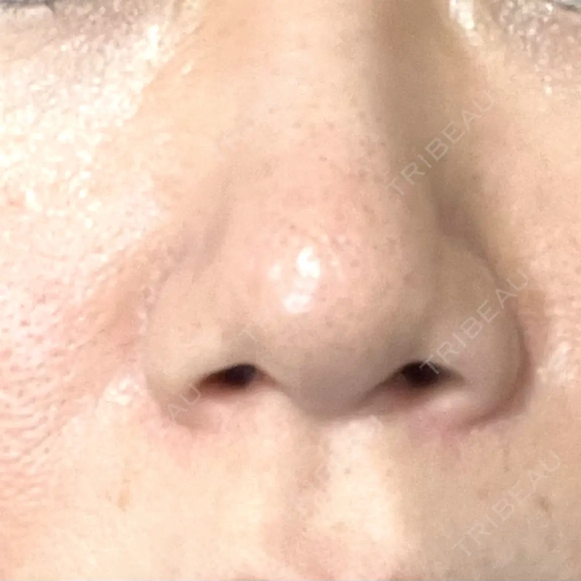 ボトックス（眉間） / 医療脱毛（顔） 共立美容外科 新宿本院 AFTER